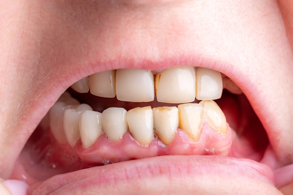 teeth-enamel-erosion