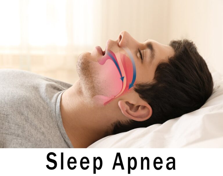 sleep-apnea-mouth-breathing