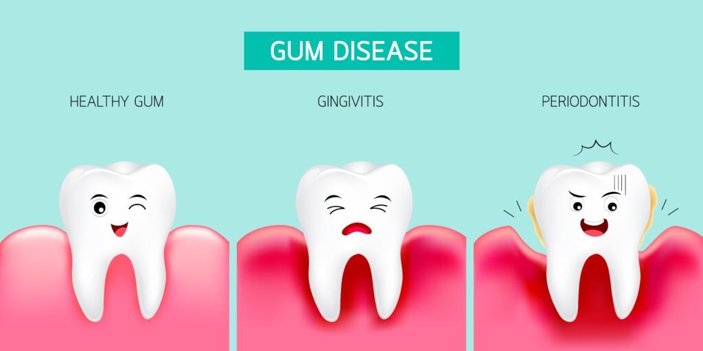 gum-disease-types