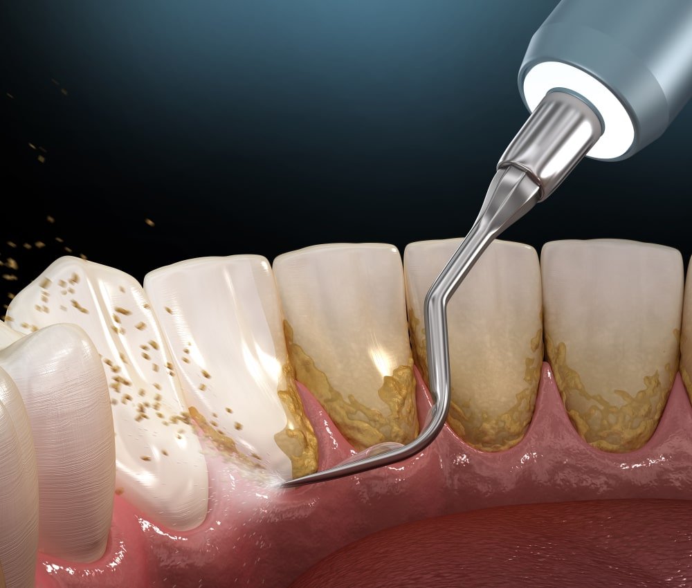 plaque-teeth