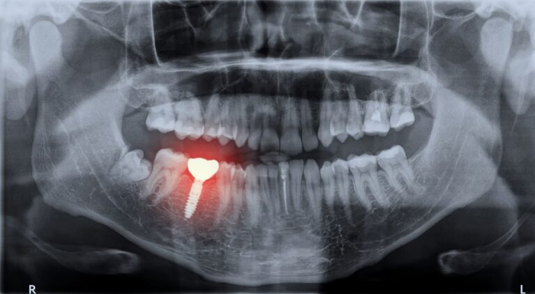 tooth-replacement
