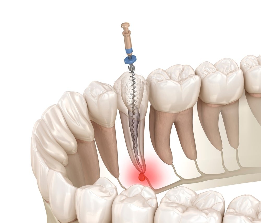 root-canal-pain
