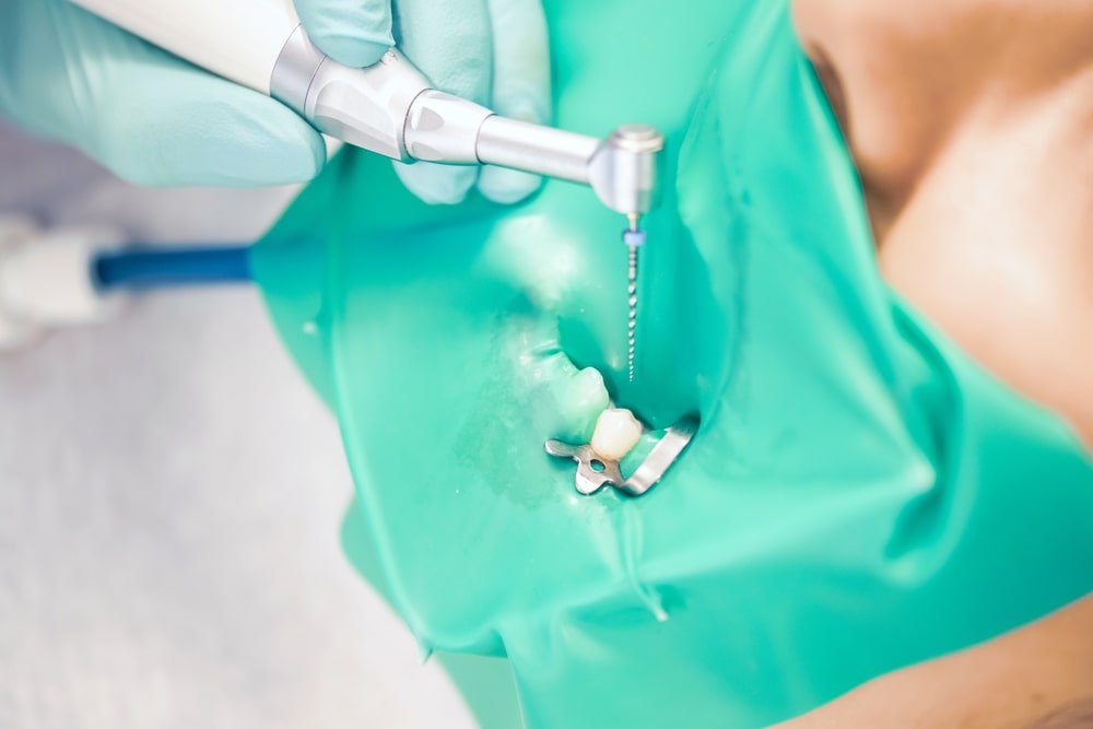 post-procedure-root-canal
