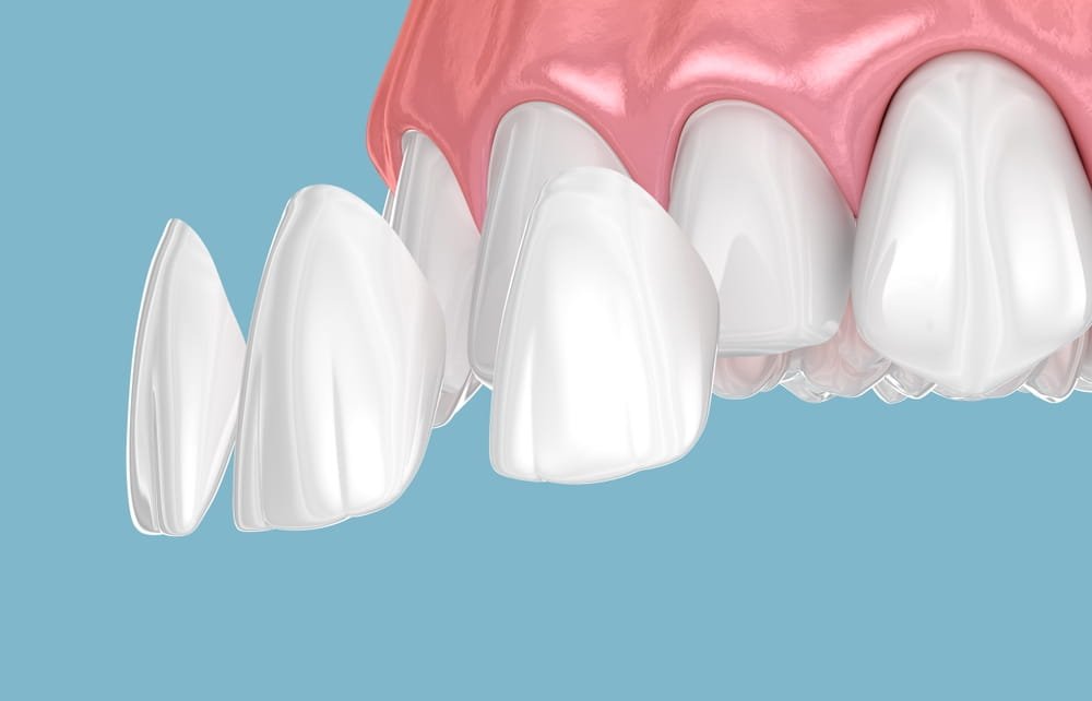 porcelain-veneers