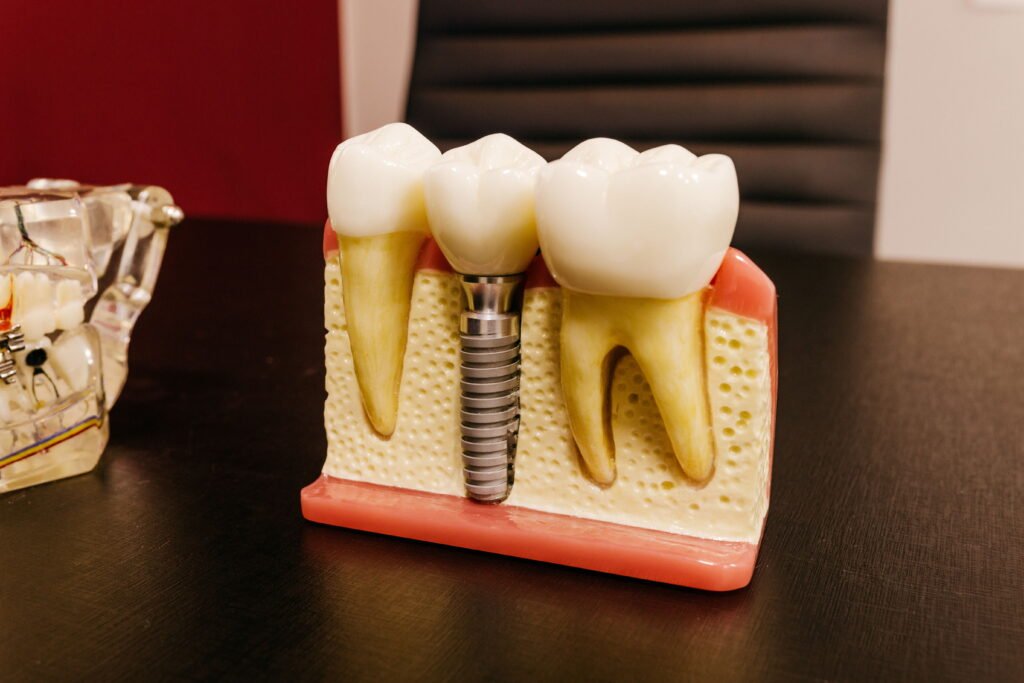dental implant cost 2026